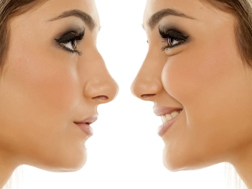 رینوپلاستی چیست و چه کسانی کاندیدای مناسب جراحی بینی هستند؟
