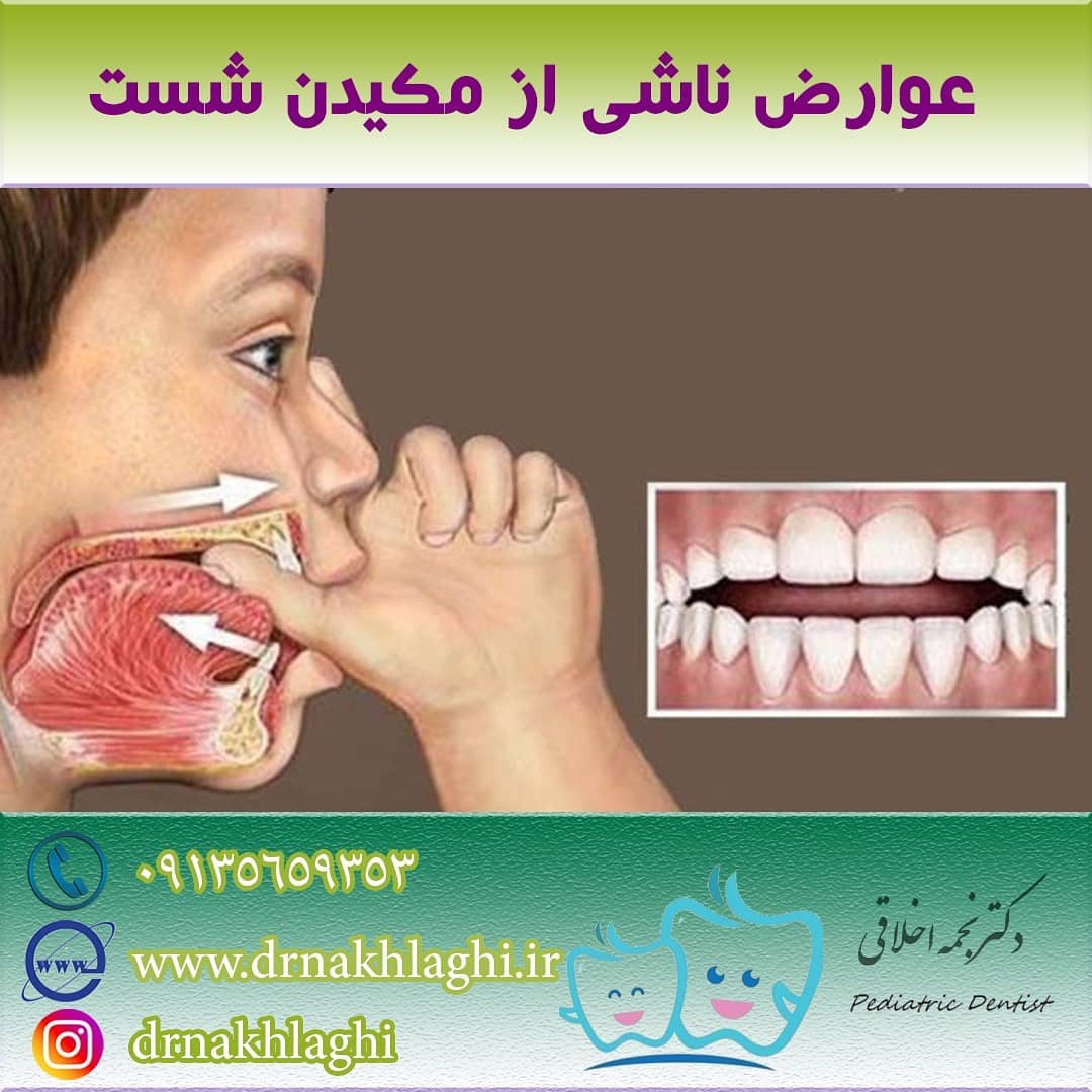 عوارض ناشى از مكیدن شست