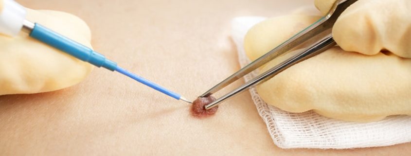 برداشتن خال و زگیل