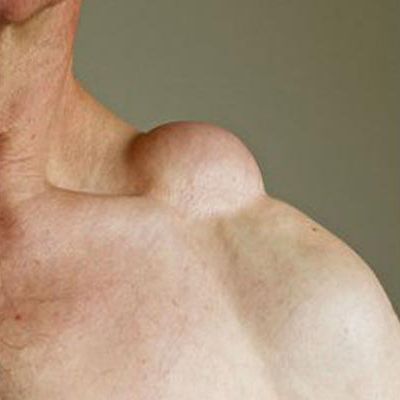 جراحی لیپوم بزرگ