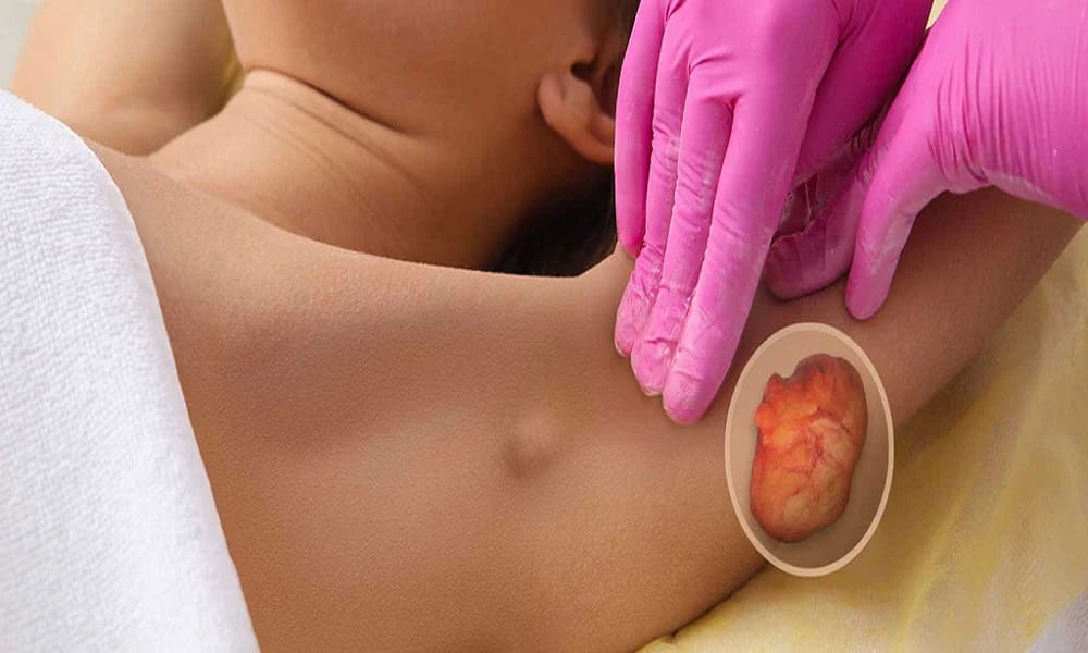 جراحی لیپوم کوچک