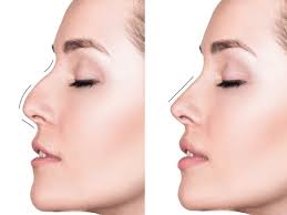 لیفت بینی با نخ