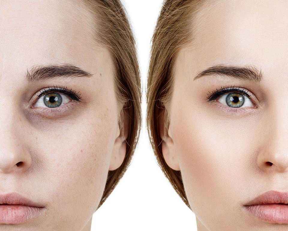 مزو روشن کننده دورچشم